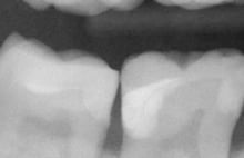 Radiograph-after-small-300x194