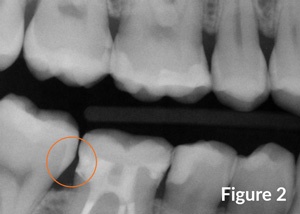 Radiograph-circle-around-dented-band-300x214